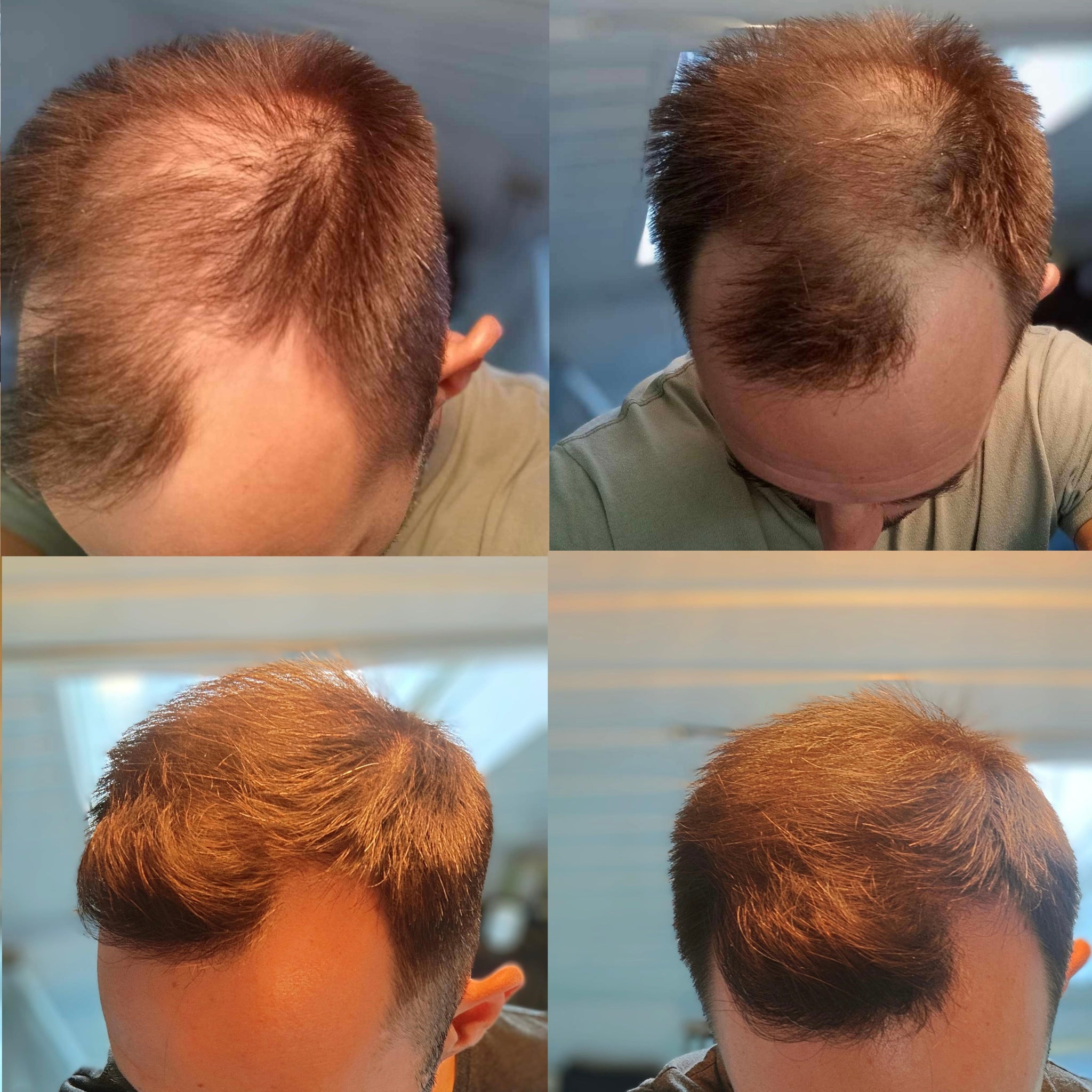 Hair Regrowth Therapy Cap